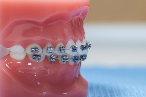 Braces & Invisalign